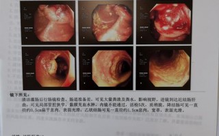 结肠镜检查结果模板图