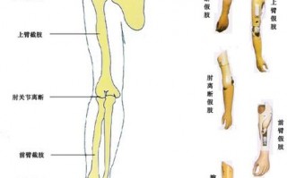 上肢假肢制作步骤-上肢假肢处方模板