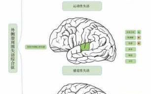 感觉性失语症状例子-感觉性失语病历模板