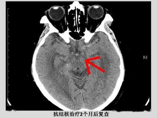 脑结核死亡模板,脑结核会死吗 -第1张图片-马瑞范文网