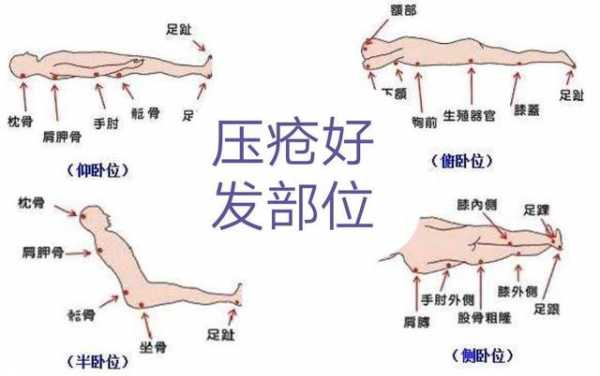 压疮的护理健康教育-第3张图片-马瑞范文网