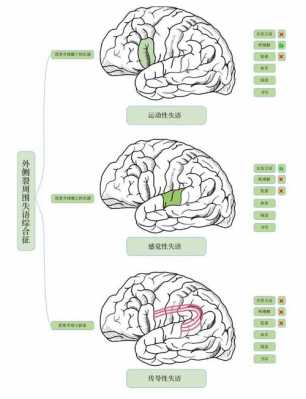 感觉性失语症状例子-感觉性失语病历模板-第1张图片-马瑞范文网